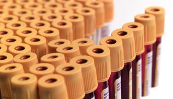 HIV blood samples