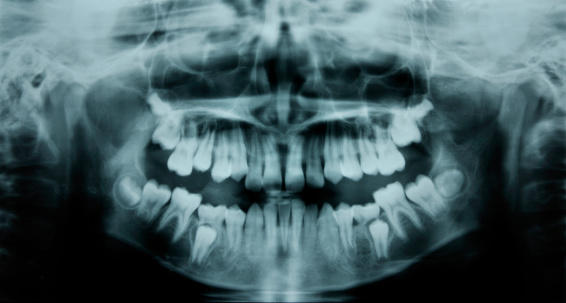 DOES HYDROGEN PEROXIDE DAMAGE YOUR TEETH ? | Magic 95.5 FM