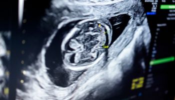 Doctor used an Ultrasound sonogram monitor for the fetus 12 weeks patient pregnant