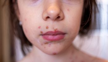 A girl with chicken pox