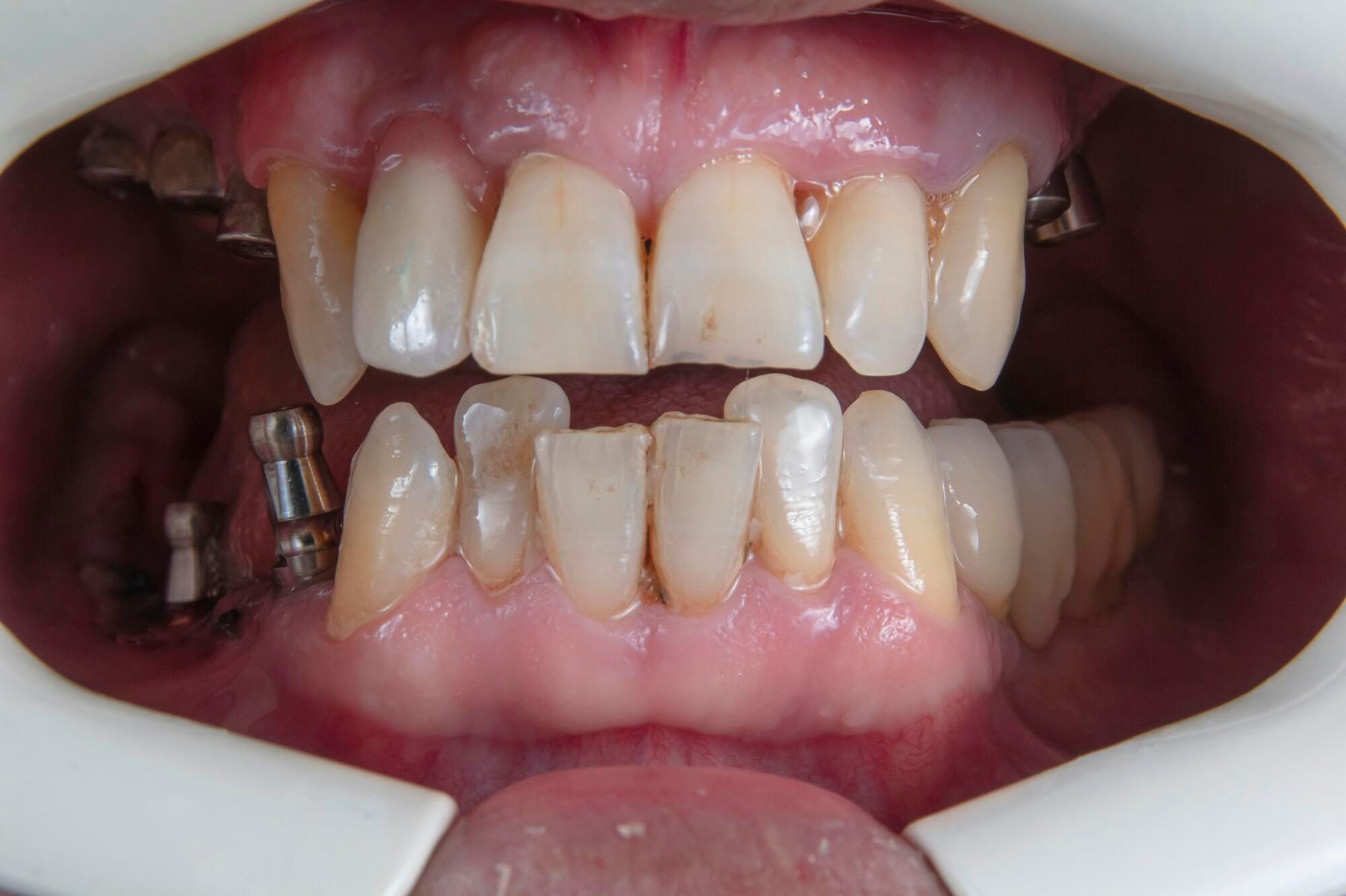 Surprising reasons adults avoid replacing missing teeth for years